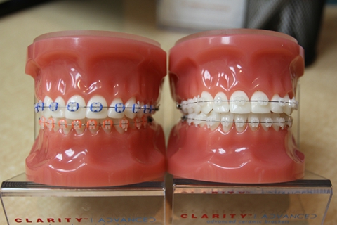 Clarity™ Ceramic Brackets, Dentist, Pershing Orthodontics
